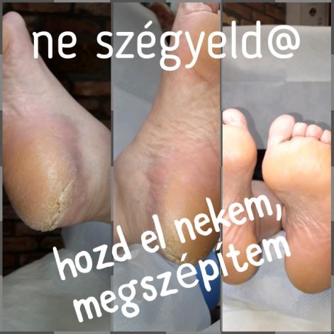 pedikur_tyukszem_sarokrepedes_benottkorom_mystic.jpg pedikur_tyukszem_sarokrepedes_benottkorom_mystic.jpg