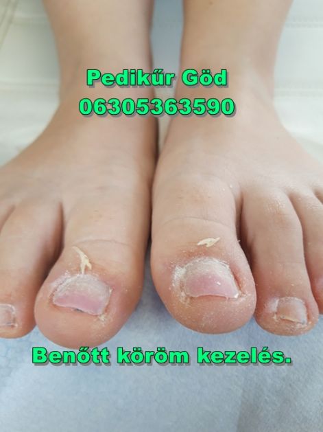 pedikurgod_benottkoromkezeles_koromvagas_gyulladt_korom.jpg